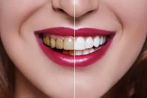 Teeth Whitening 美白牙齒