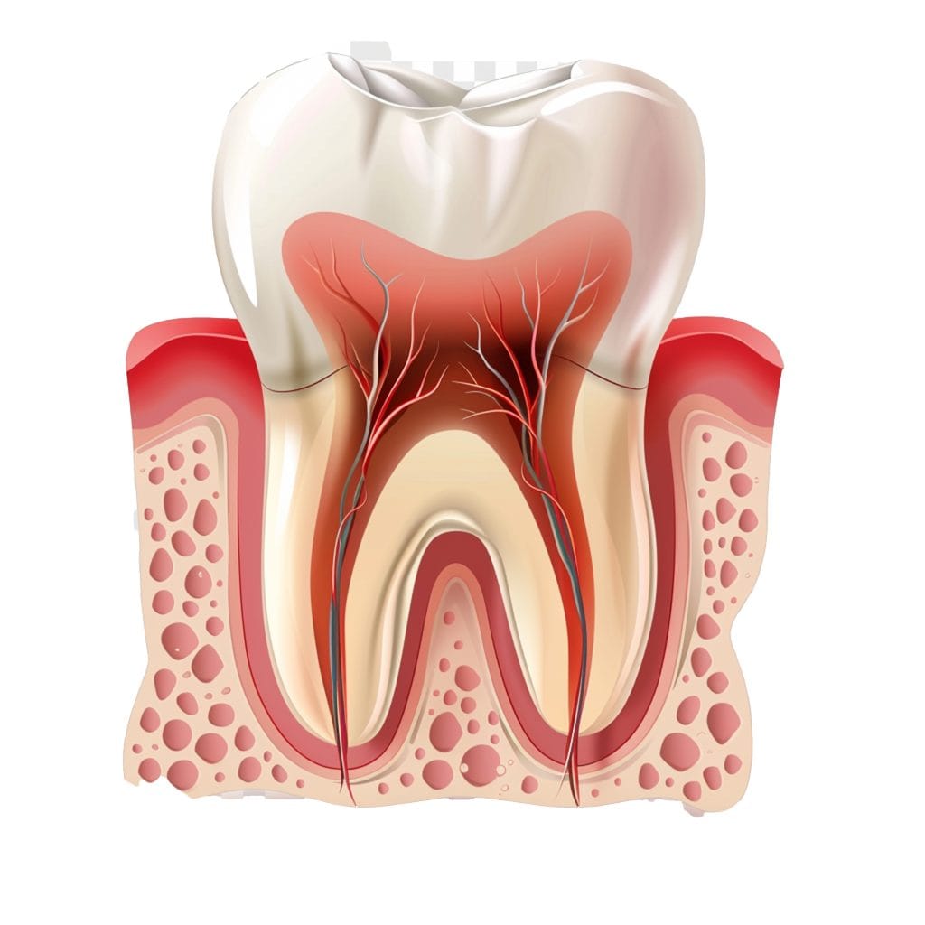 root canal 杜牙根 (根管治療)