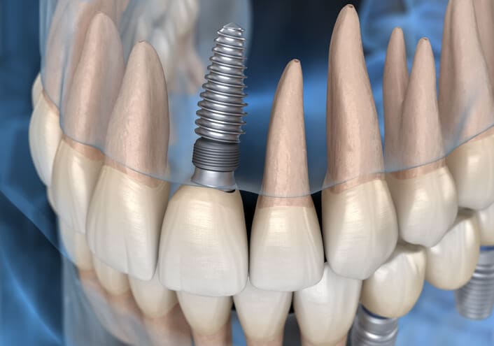 Dental Implants 種牙植牙