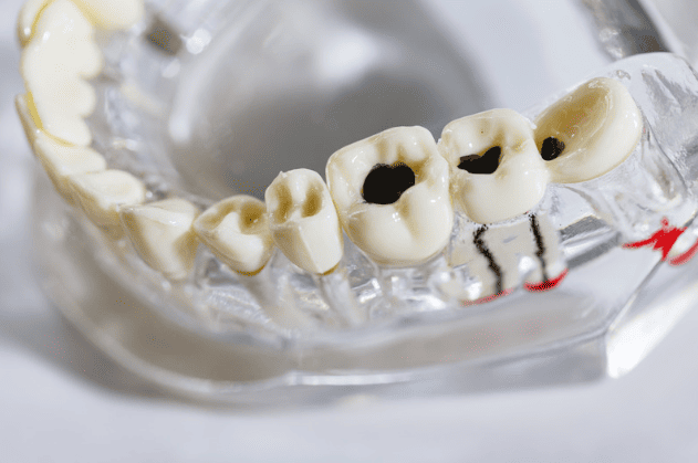 Benefits of Tooth Fillings 補牙的好處