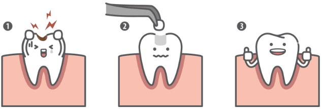 The Tooth Filling Procedure 補牙流程