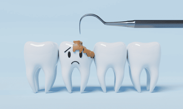 Tooth Fillings Guide 補牙全面指南