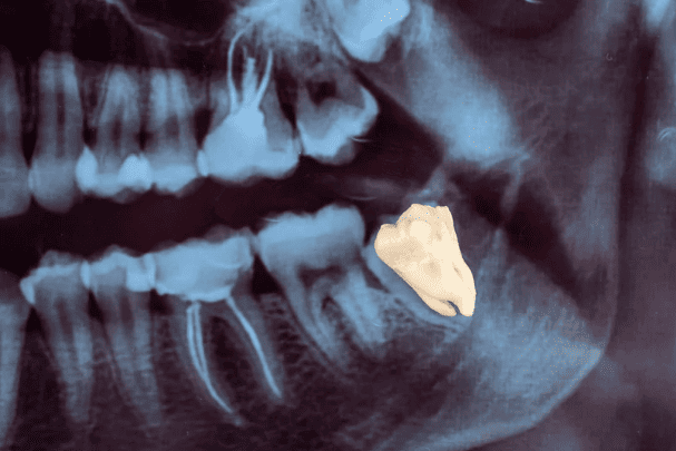 When Should Wisdom Teeth Be Removed 什麼情況需要剝智慧齒？