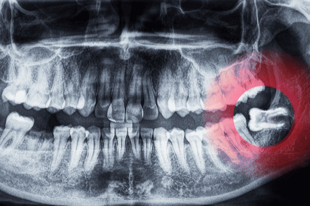 Wisdom Teeth Common Problems 智慧齒常見問題