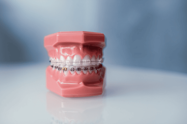 brace orthodontic info price process 箍牙全面資訊