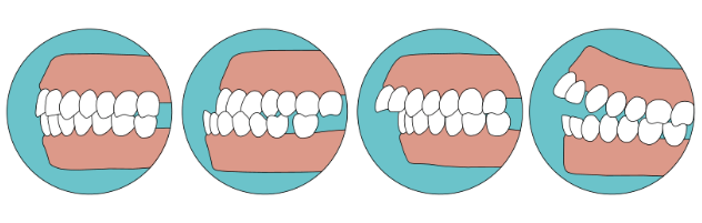 malocclusion bite problems 咬合不正問題