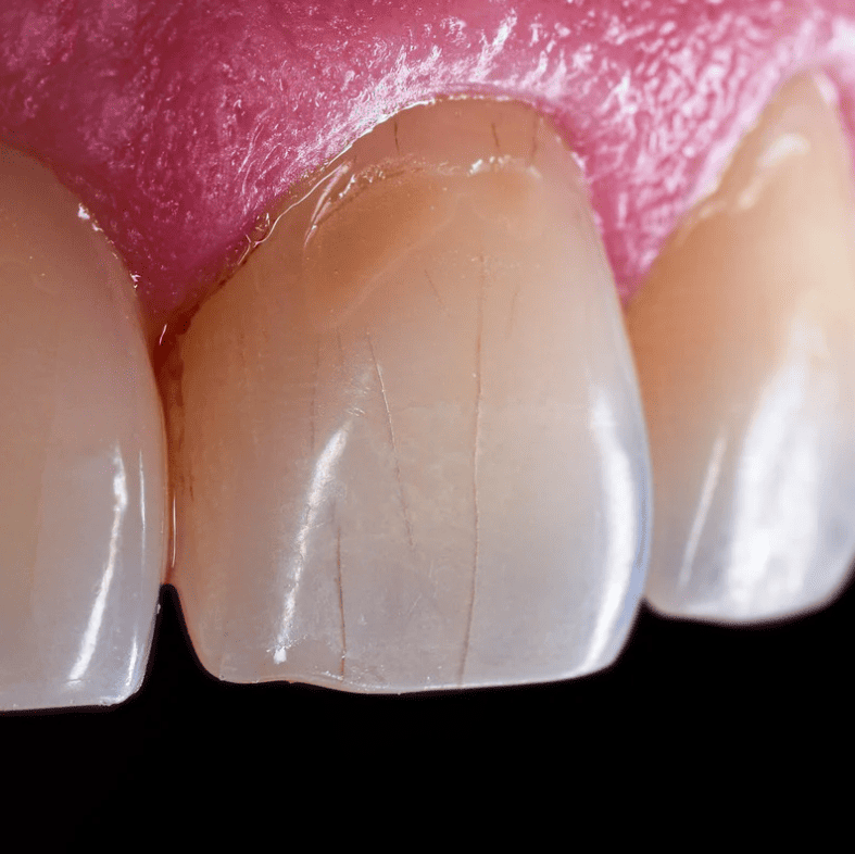 How is tartar formed 牙石是如何形成