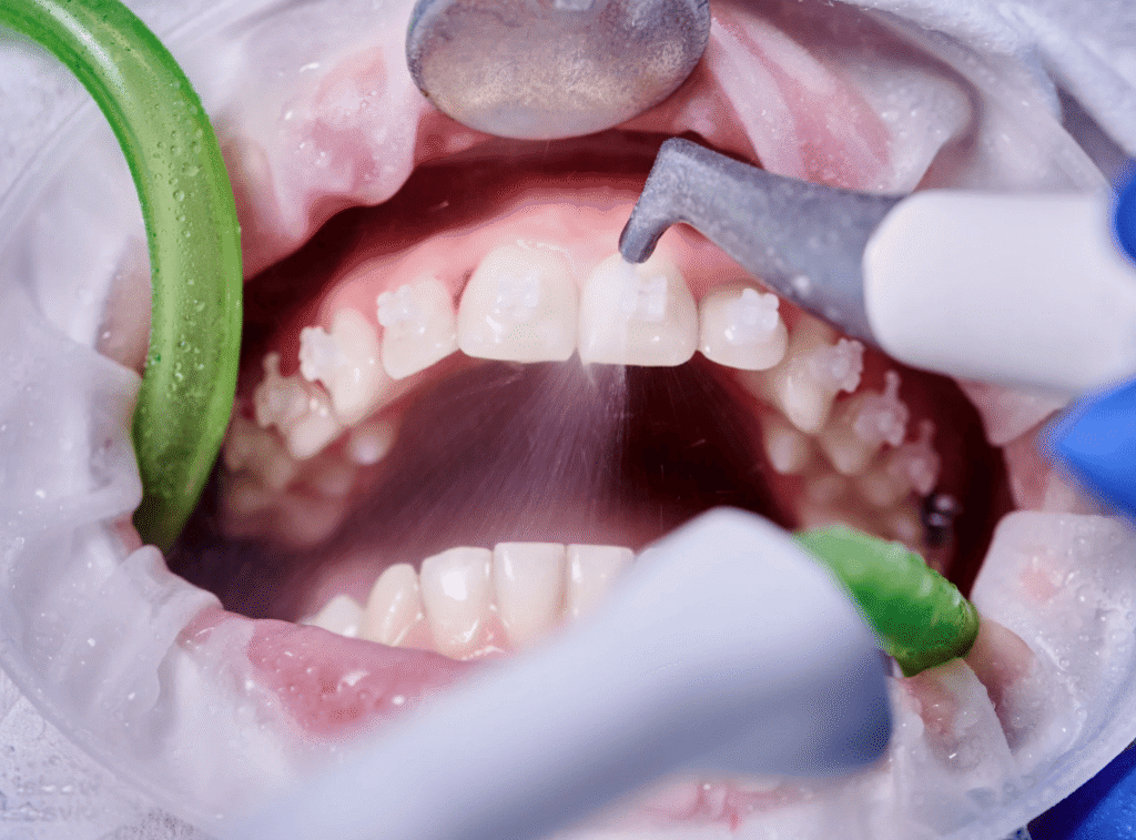 Teeth Cleaning Guide 洗牙完整指南