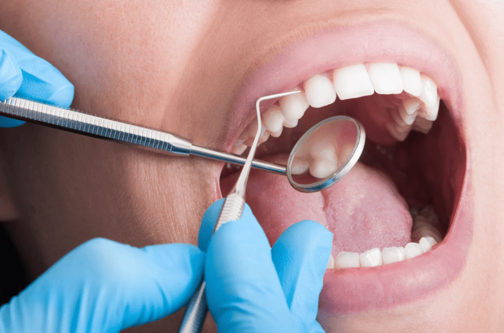 What is teeth cleaning 洗牙是什麼