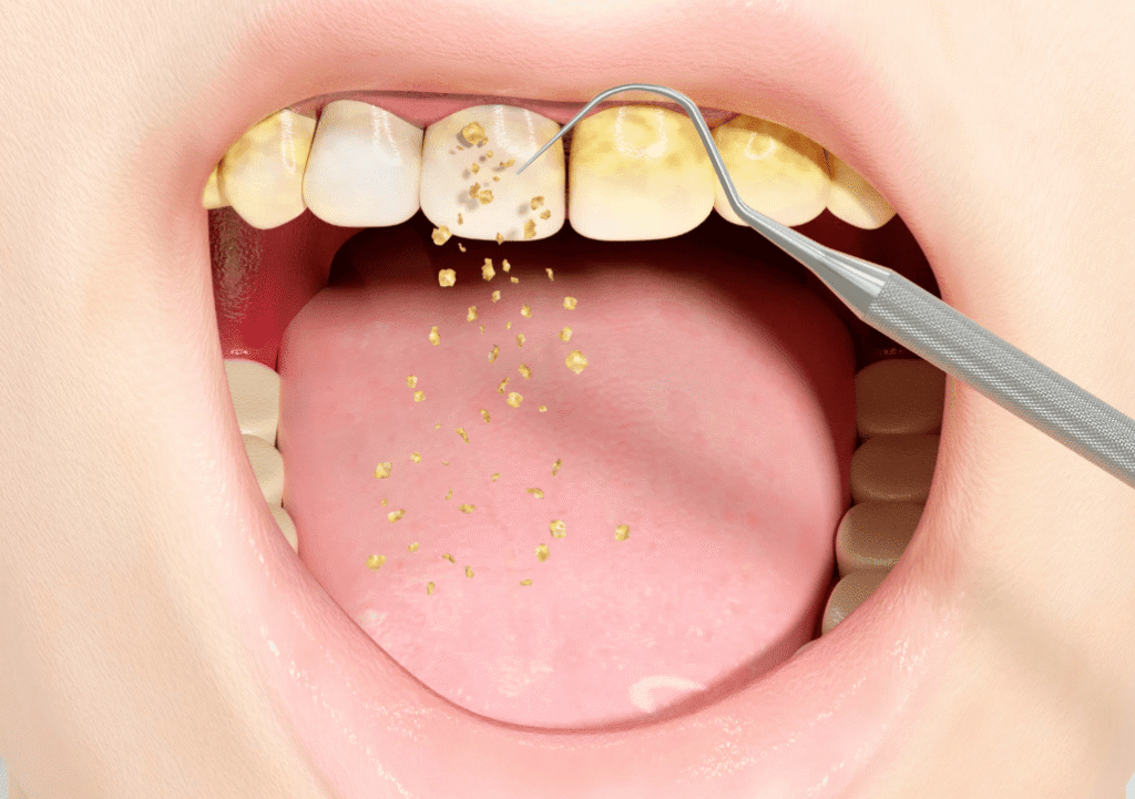 teeth cleaning process 洗牙過程詳解