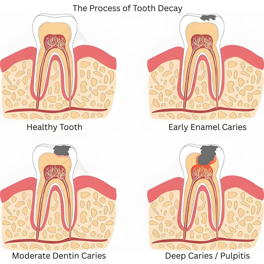 A dental anatomy diagram illustrating the four stages of Cavities: healthy tooth, early enamel caries, moderate dentin caries, and deep caries / pulpitis.