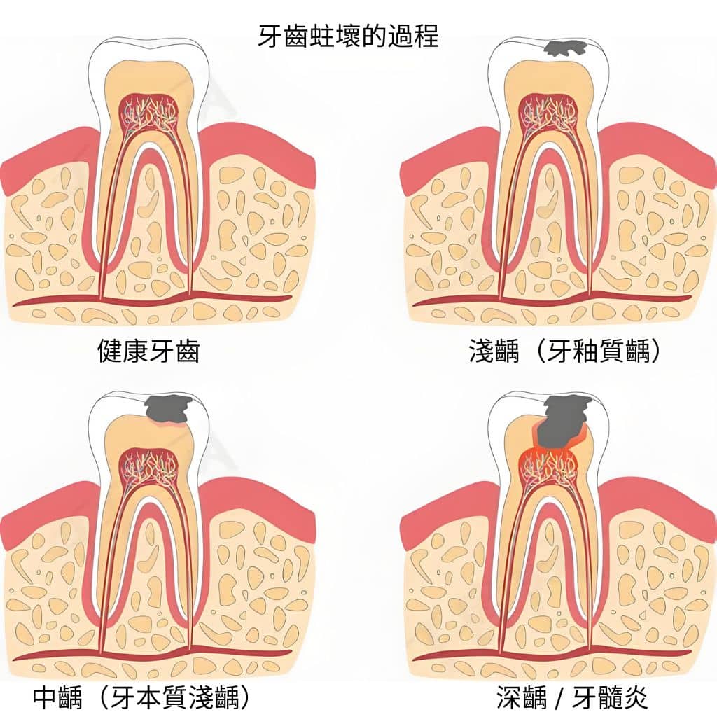 是呈現蛀牙四階段（健康牙齒、淺齲、中齲、深齲／牙髓炎）的牙齒解剖示意圖