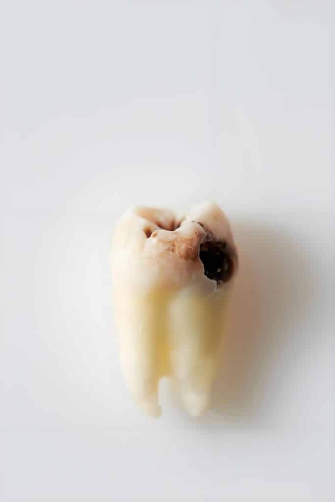 齲齒牙齒特寫:帶有明顯齲洞與齲壞的蛀牙