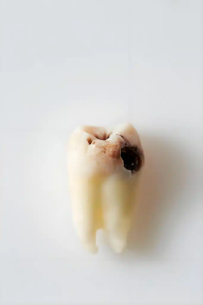 齲齒牙齒特寫：帶有明顯齲洞與齲壞的蛀牙
