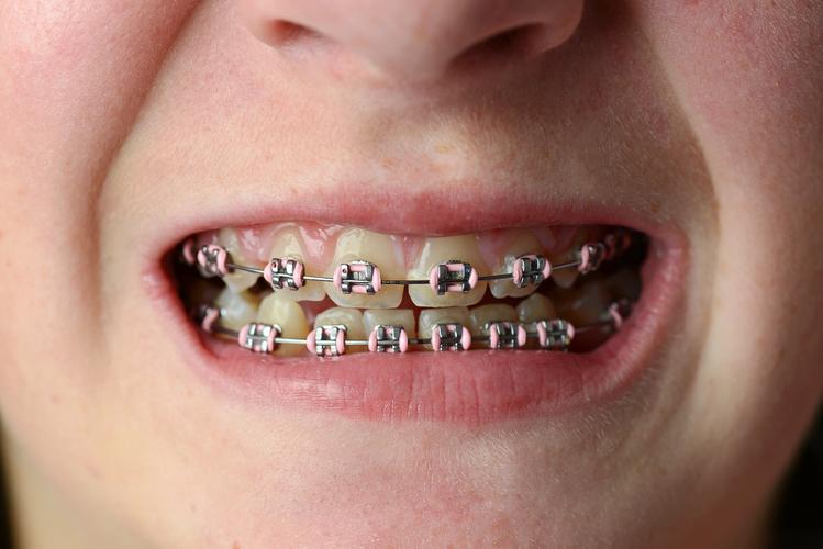 Close-up of a teenager's mouth with metal braces (pink elastic ligatures), cover image for the 2026 Teen Orthodontics Guide blog, covering Hong Kong student braces (cool teeth) options, cost reference, cleaning teeth with braces and the golden period for orthodontic treatment