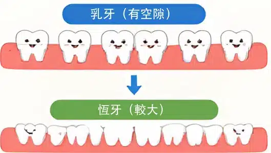 乳牙之間的空隙為較大的恆牙預留位置