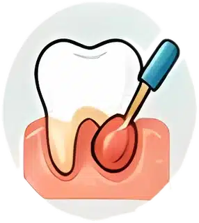 Gum treatment over an exposed root