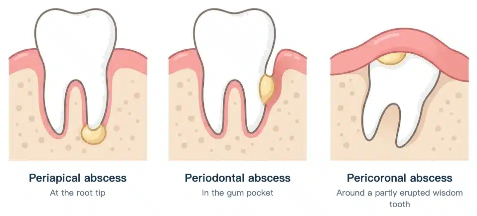 Cutaway illustration: a periapical abscess at the root tip, a periodontal abscess in the gum pocket, and a pericoronal abscess under the gum flap of a partly erupted wisdom tooth