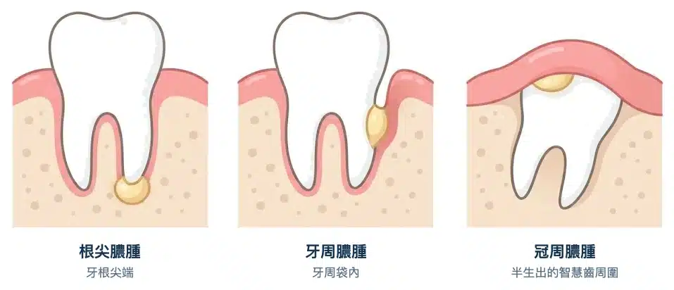 牙齒剖面示意圖：根尖膿腫在牙根尖端，牙周膿腫在牙周袋內，冠周膿腫在半生出智慧齒的牙肉蓋下