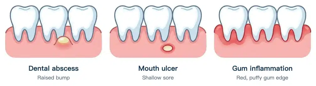 Side-by-side illustration: an abscess is a raised bump on the gum, a mouth ulcer is a shallow sore, and gum inflammation is a puffy red gum edge