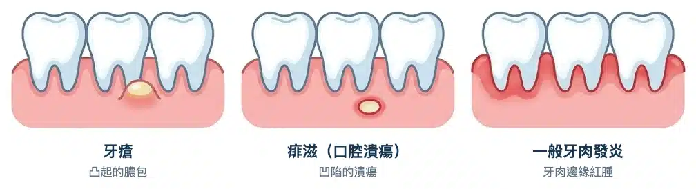 牙肉上三種情況的示意比較：牙瘡是凸起的膿包，痱滋是凹陷的潰瘍，牙肉發炎則是牙肉邊緣紅腫
