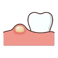 Bump on the gum