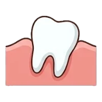 Partly erupted wisdom tooth